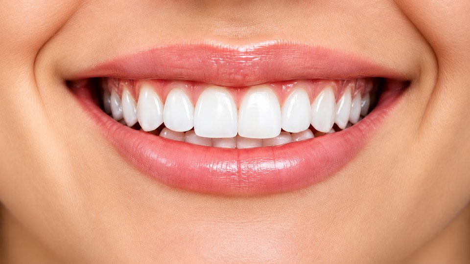 Clareamento Dental